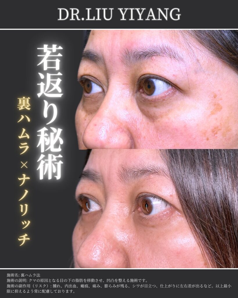 裏ハムラ法とナノリッチの症例 (1)（広島のクマ取り名医の辻一七子医師が執刀）