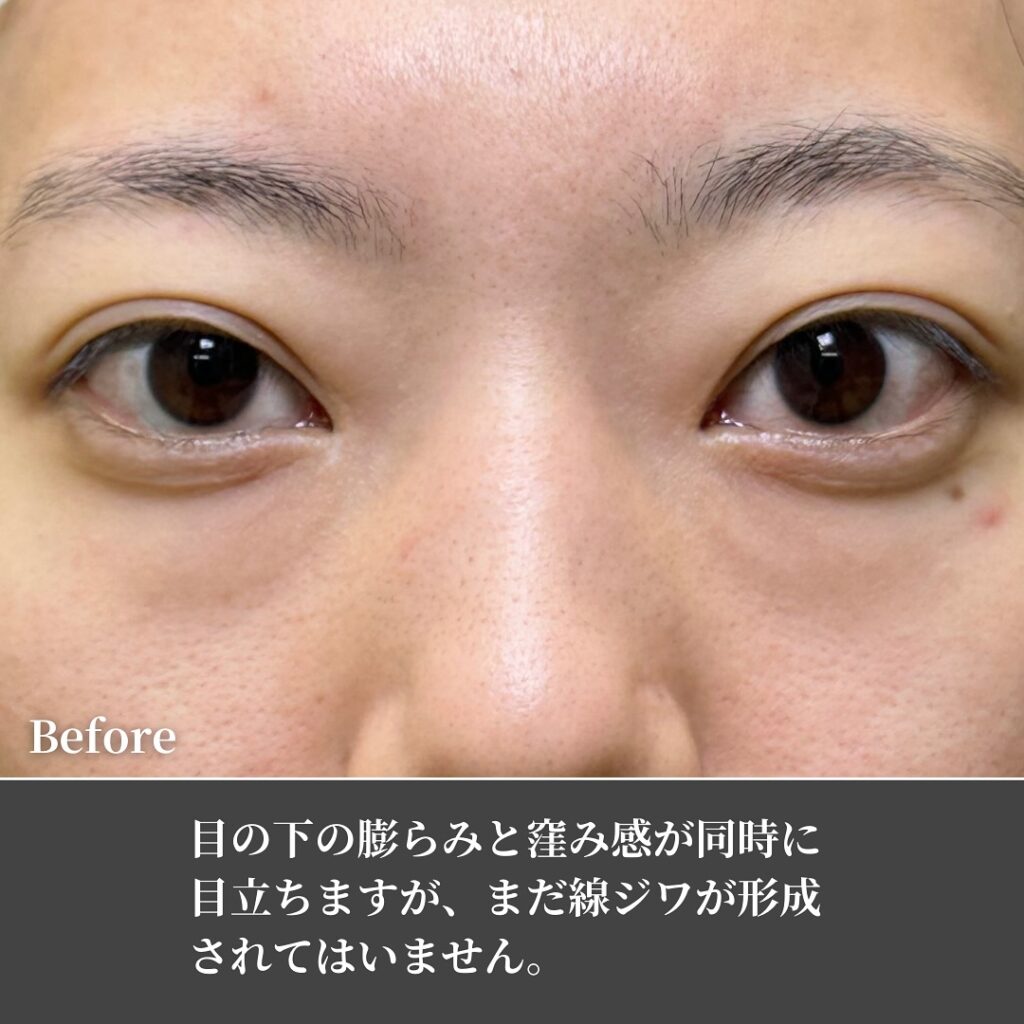 脱脂と脂肪注入の症例 (4)