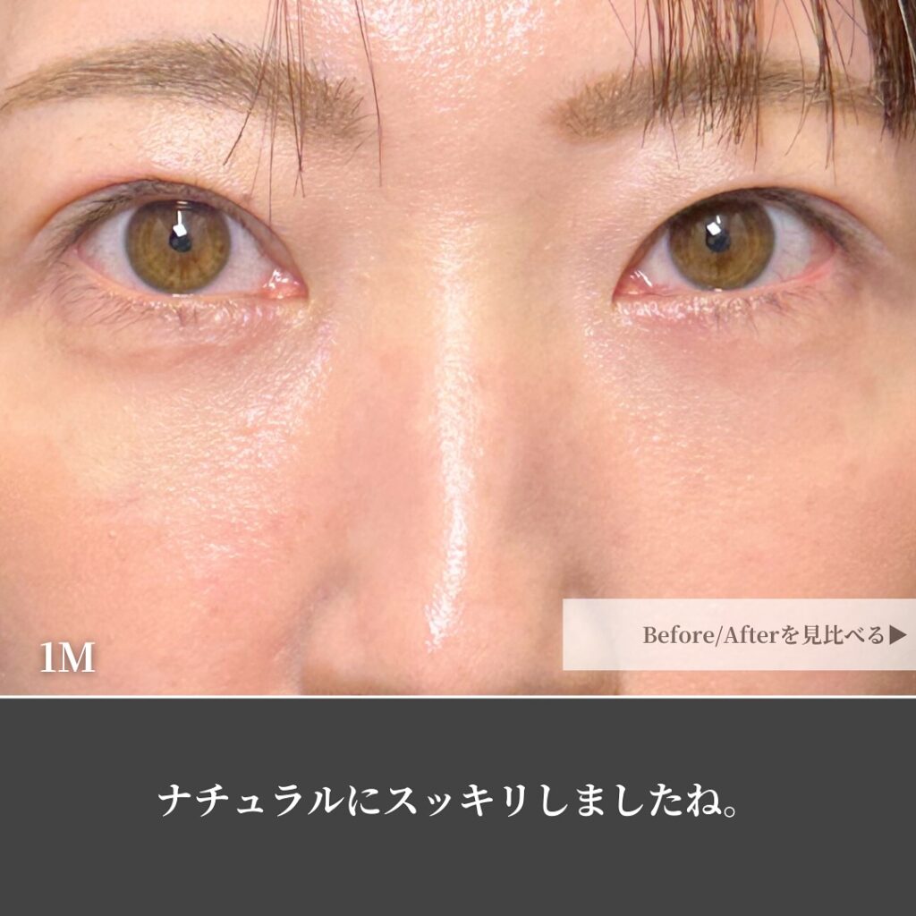 裏ハムラ法と埋没法の症例写真 (3)