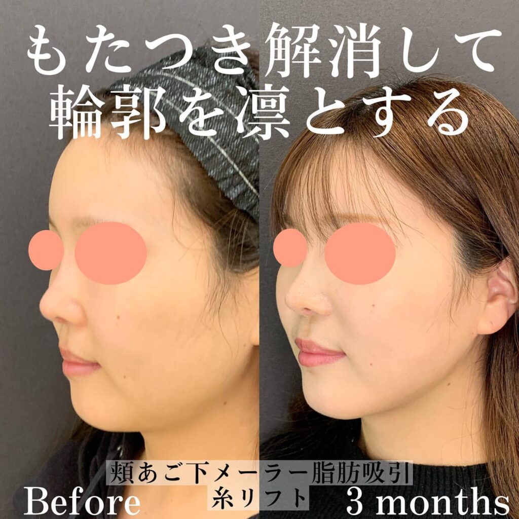 eclinicc広島院の脂肪吸引症例写真