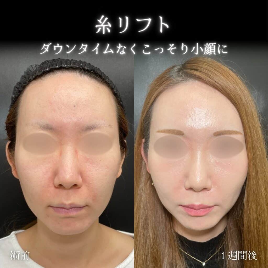 eclinic広島院の糸リフト症例写真