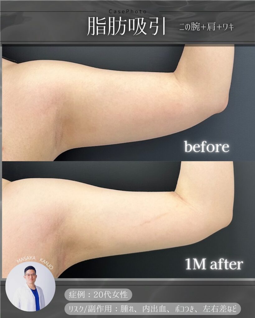 二の腕の脂肪吸引の症例写真 (3)