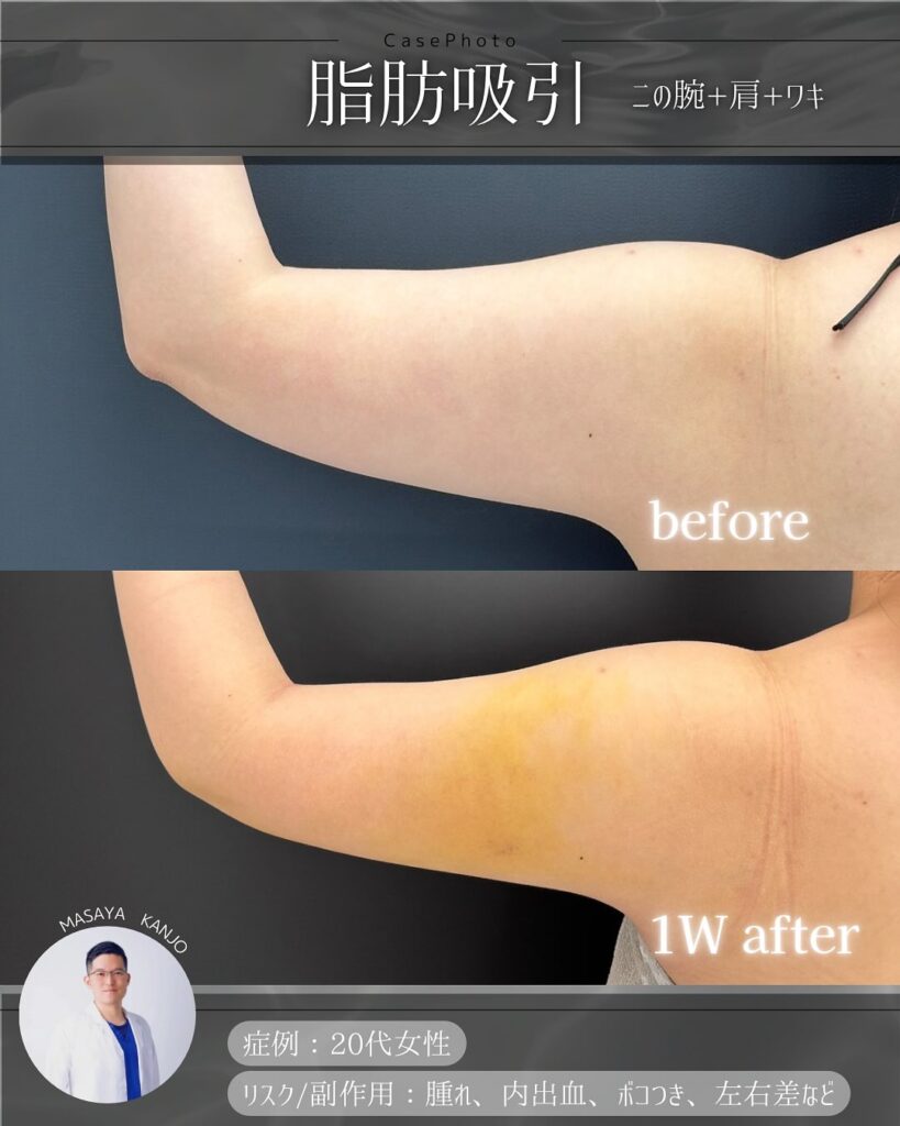 二の腕の脂肪吸引の症例写真 (4)