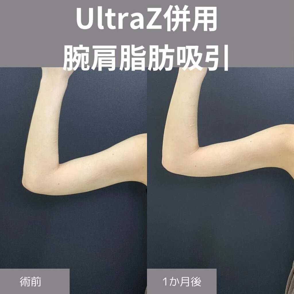 Ultrasで腕肩の脂肪吸引を受けた細見の女性の症例