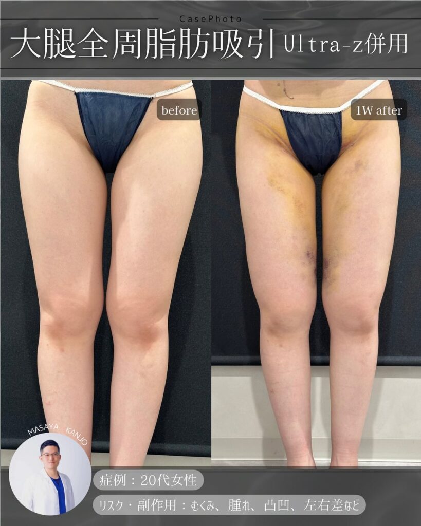 大腿全周脂肪吸引の脂肪吸引 (1)