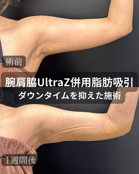 Ultras併用二の腕、肩、ワキ脂肪吸引の経過の症例