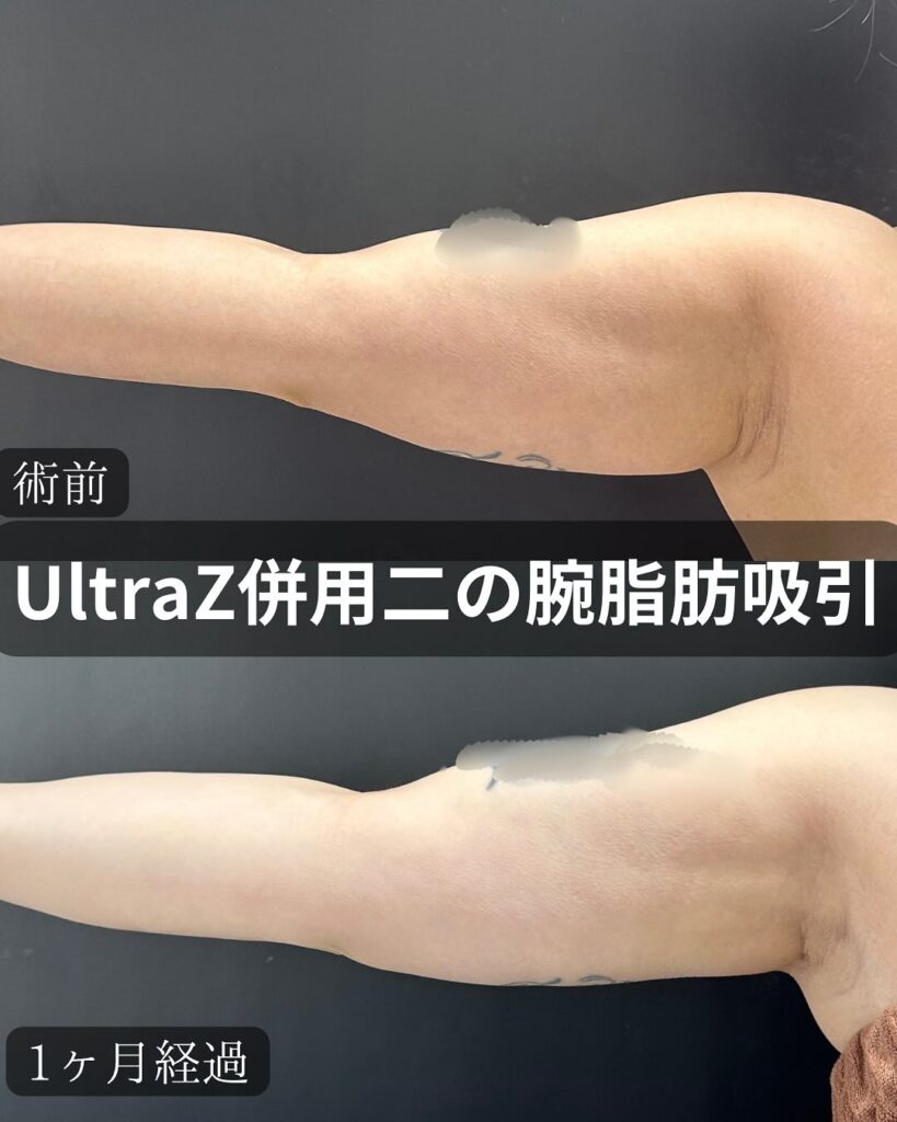 二の腕の脂肪吸引の症例写真 (6)
