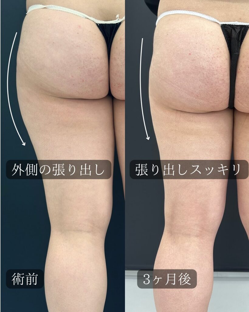 Ultrasの大腿後面、外側、お尻の脂肪吸引後3ヶ月経過の症例写真