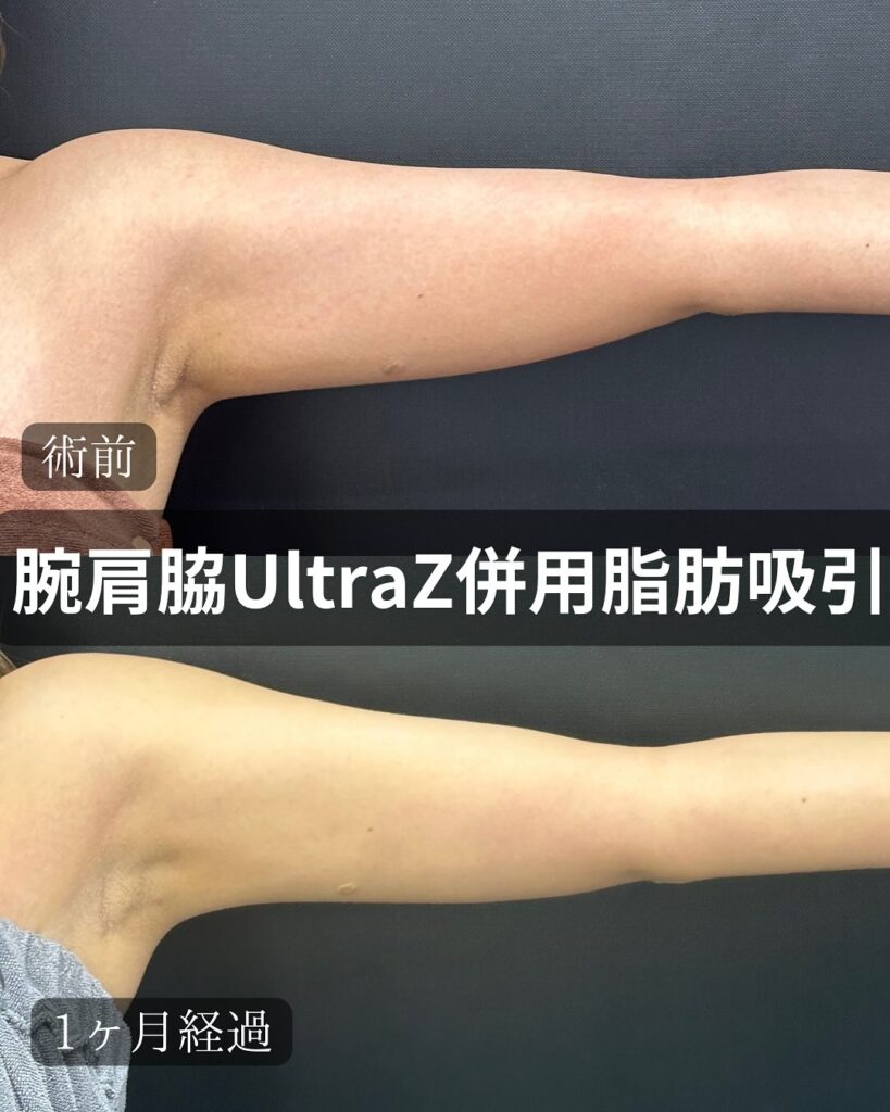 二の腕の脂肪吸引の症例写真 (5)