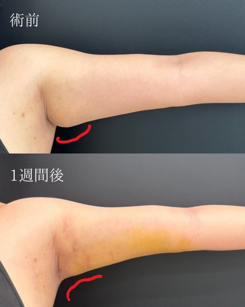 二の腕の脂肪吸引の1週間後の経過の症例
