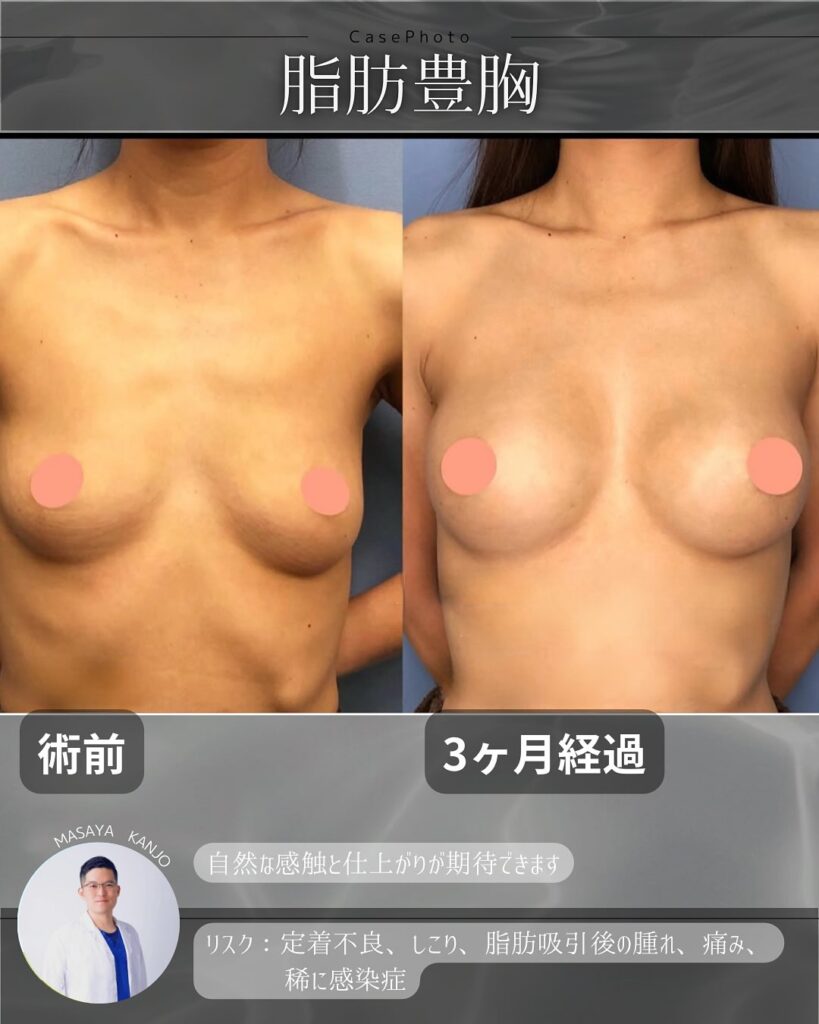 脂肪注入豊胸の症例写真