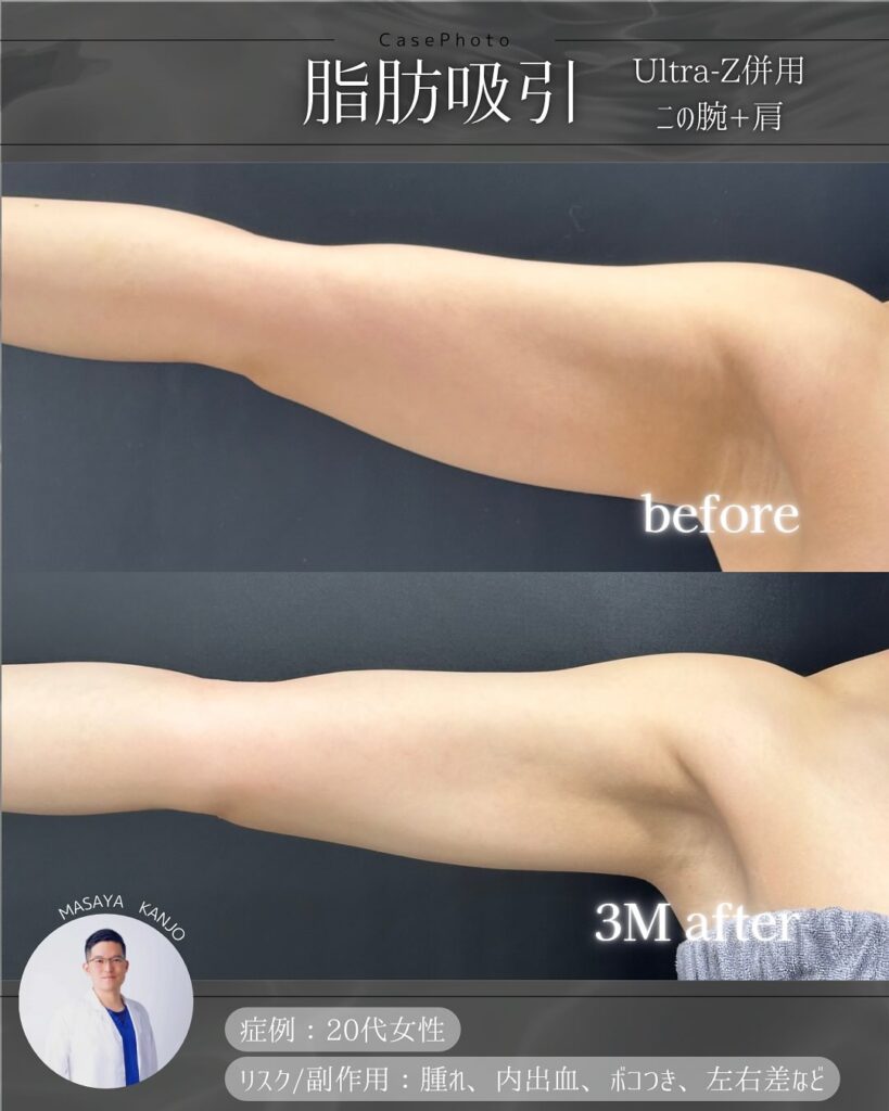 二の腕の脂肪吸引の症例写真 (2)