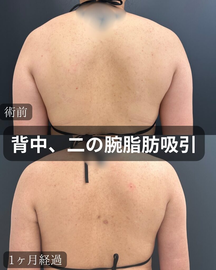 背中の脂肪吸引の症例写真