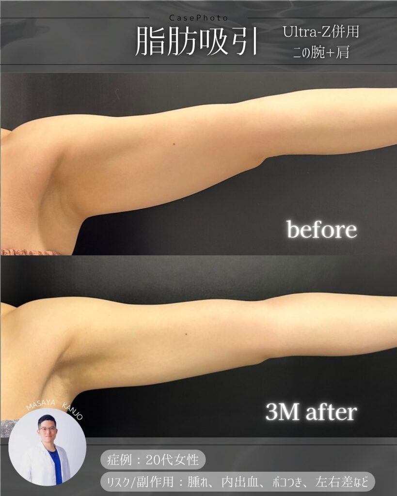 二の腕の脂肪吸引の症例写真 (1)
