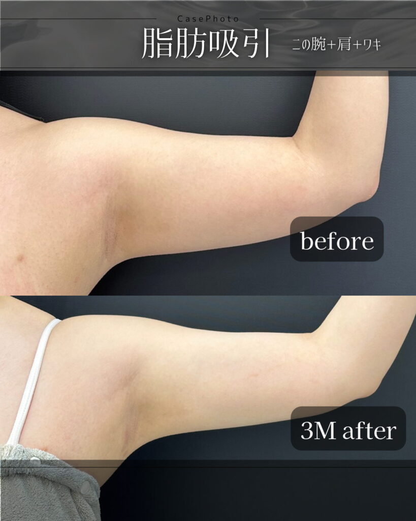 二の腕の脂肪吸引の症例写真 (3)