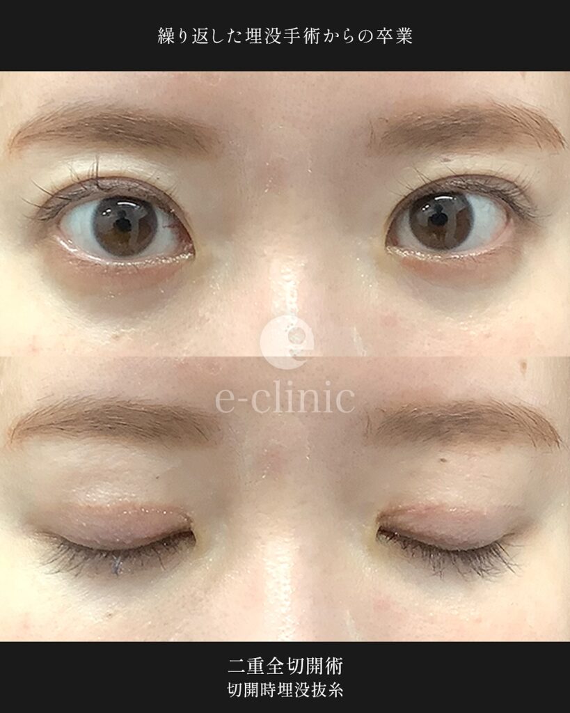 全切開法と埋没糸抜糸併用の症例写真 (5)