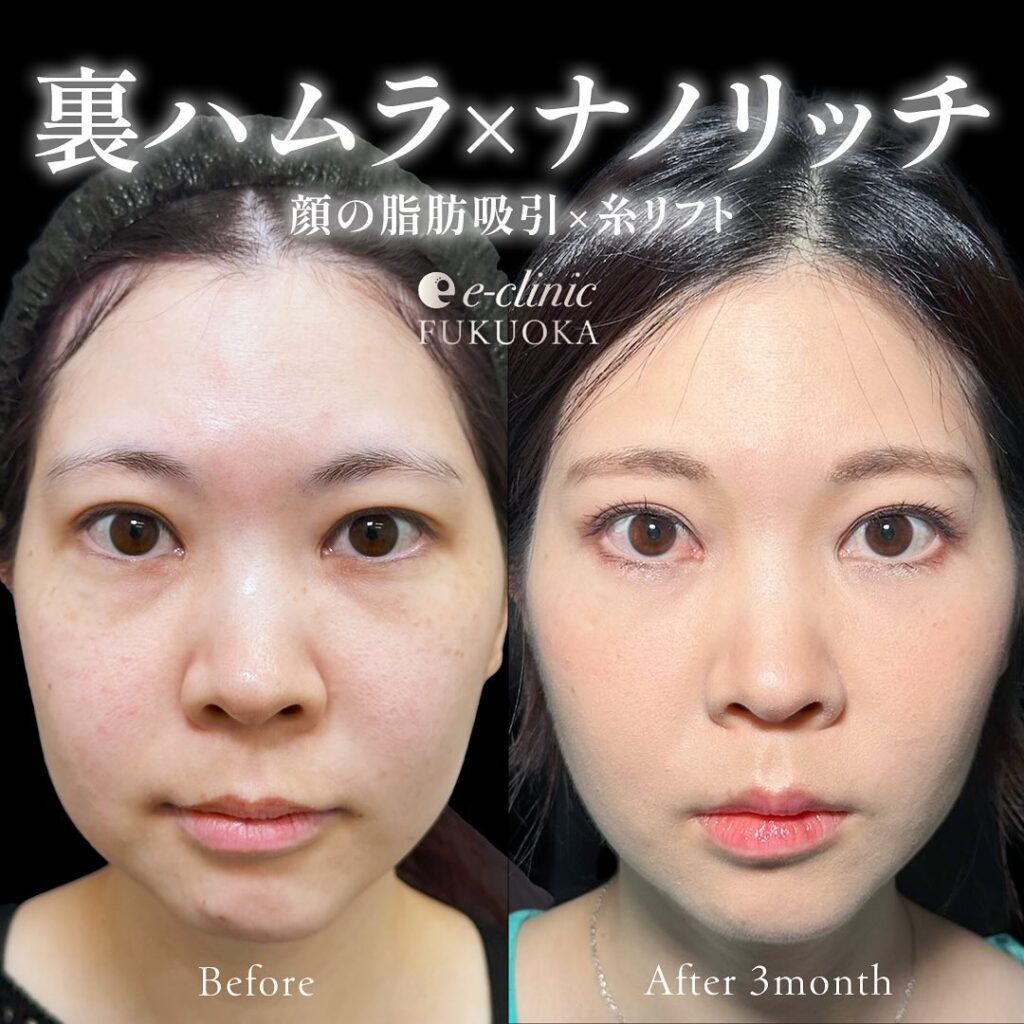 裏ハムラ法とナノリッチの症例写真 (7)