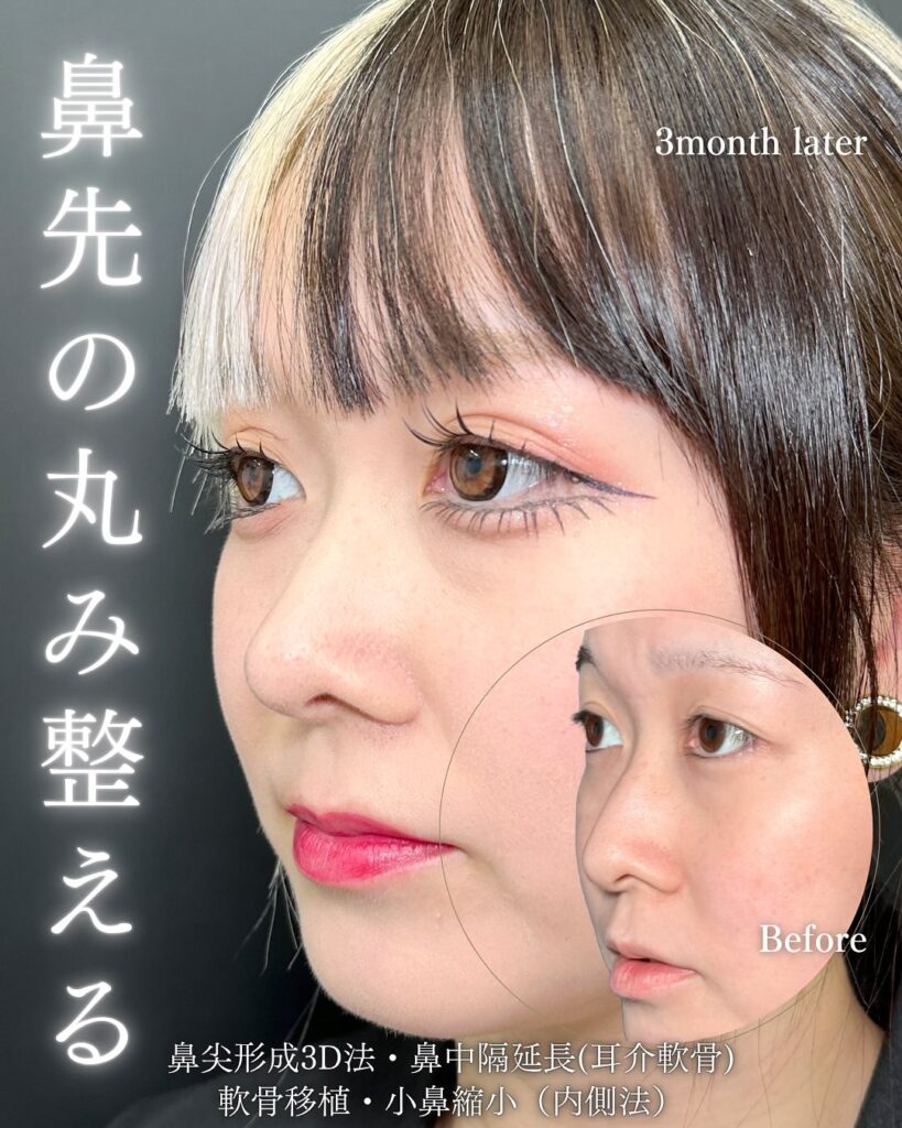鼻中隔延長と鼻尖形成と軟骨移植と小鼻縮小の症例写真 (1)