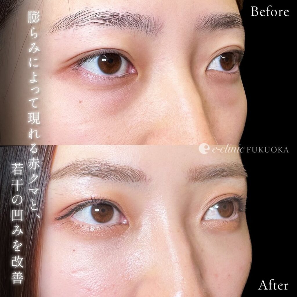 裏ハムラ法の症例写真 (6)