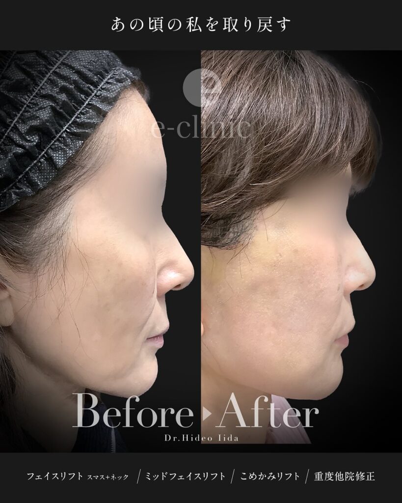 スマスフェイスリフトとネックリフトとミッドフェイスリフト（中顔面リフト）とこめかみリフトの症例写真 (3)