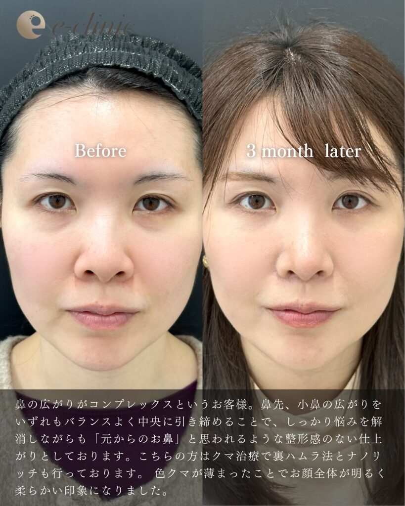 鼻尖形成と耳介軟骨移植と小鼻縮小と裏ハムラと目の下の脂肪注入の症例写真 (3)