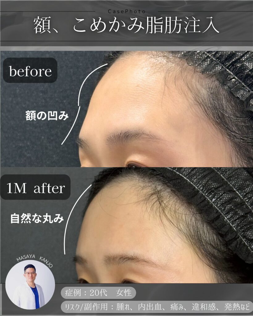 額とこめかみの脂肪注入の症例写真 (3)