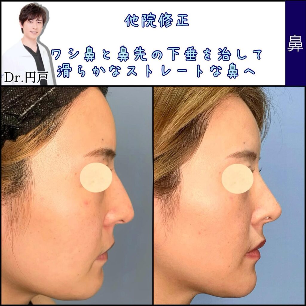 他院鼻修正術の症例写真 (2)