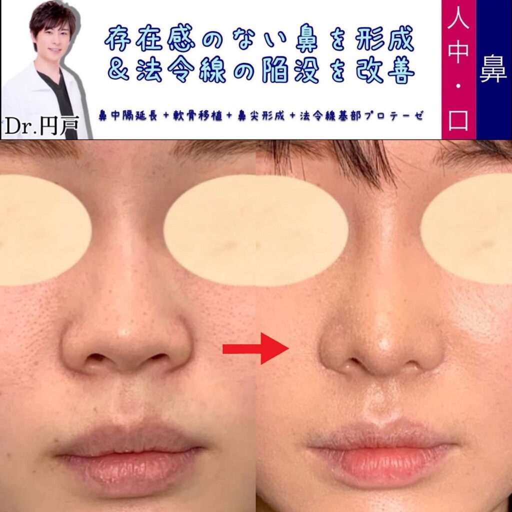 鼻中隔延長と軟骨移植と鼻尖形成と貴族手術の症例写真 (2)