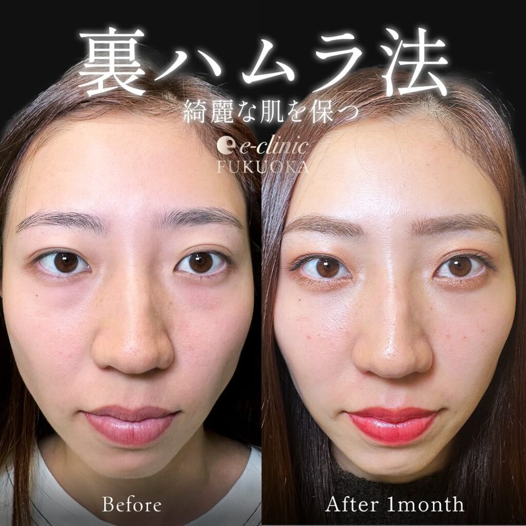 裏ハムラ法の症例写真 (4)