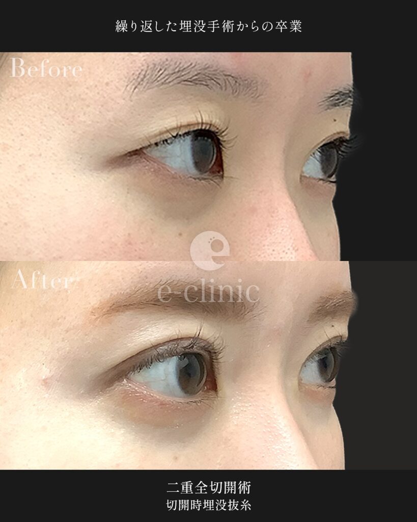 全切開法と埋没糸抜糸併用の症例写真 (1)