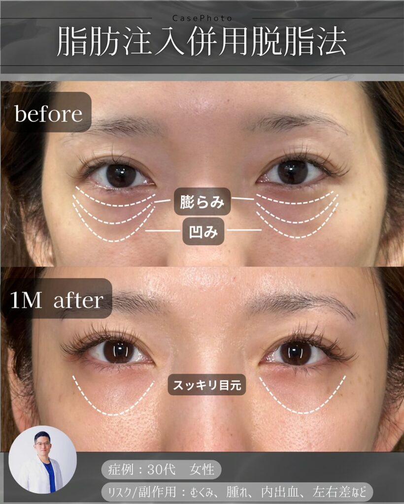 目の下の脂肪注入と脱脂の症例写真 (6)