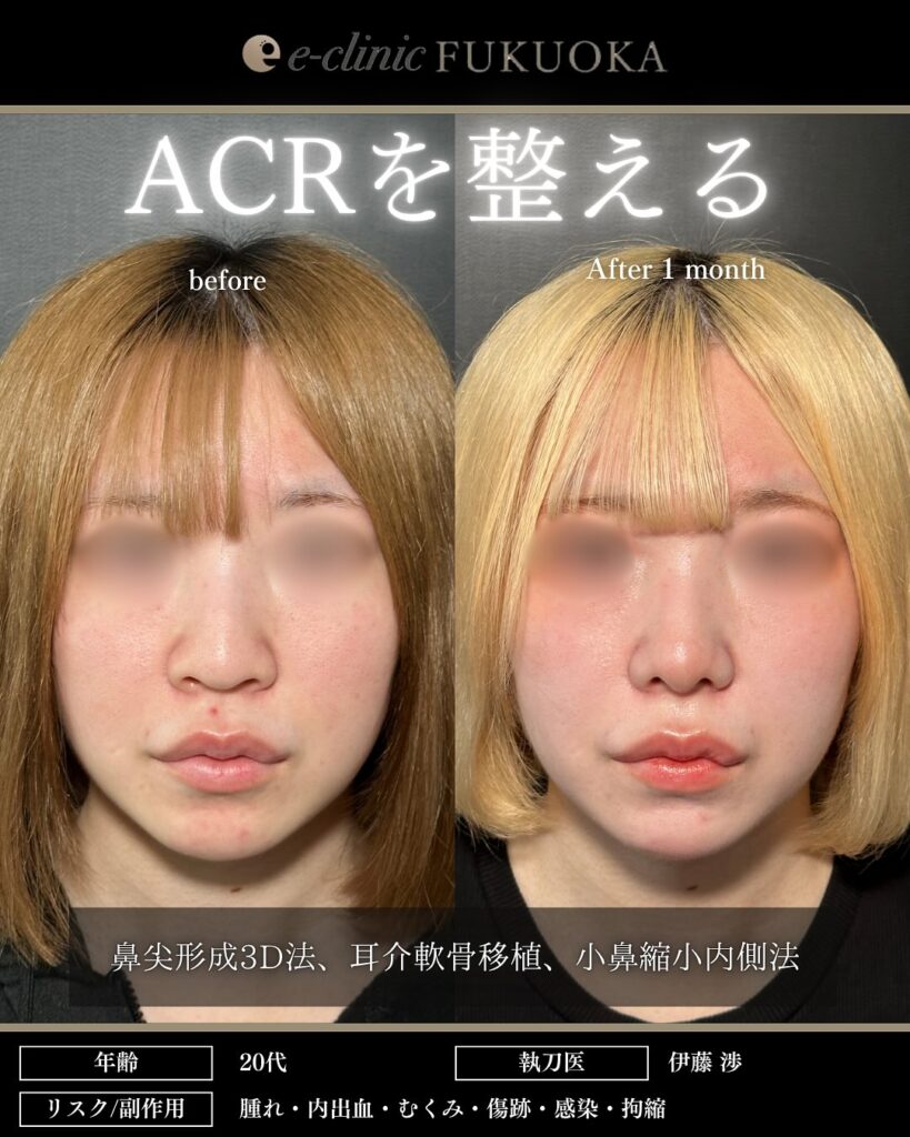 伊藤渉医師の鼻尖形成3D法、耳介軟骨移植、小鼻縮小内側法でACRを整えた症例