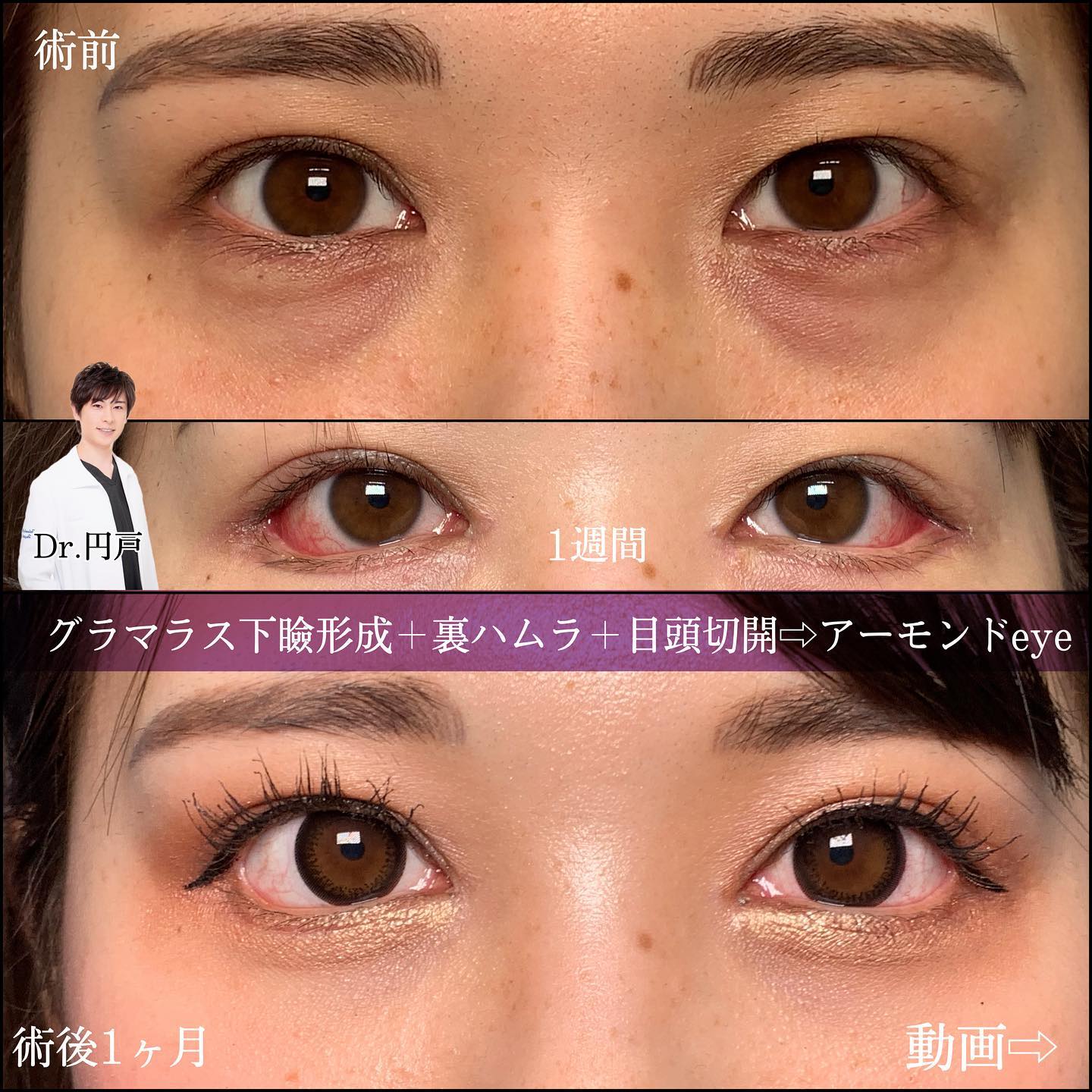 グラマラスライン形成と裏ハムラ法と目頭切開の症例写真