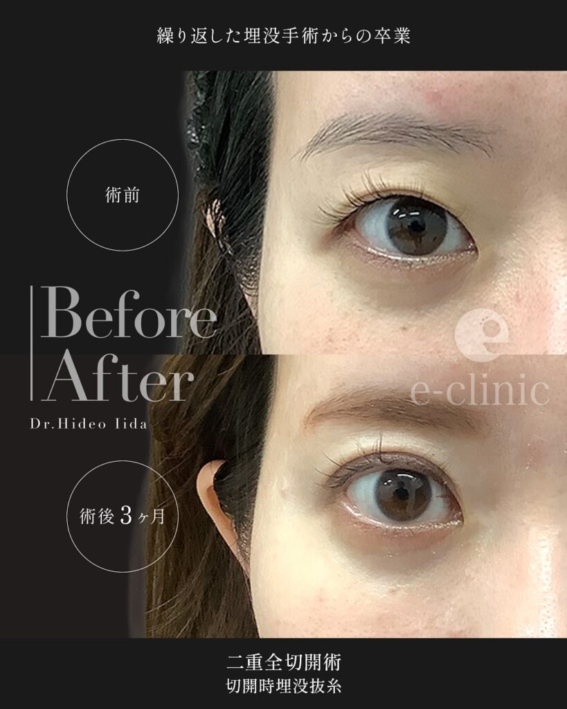 全切開法と埋没糸抜糸併用の症例写真 (4)