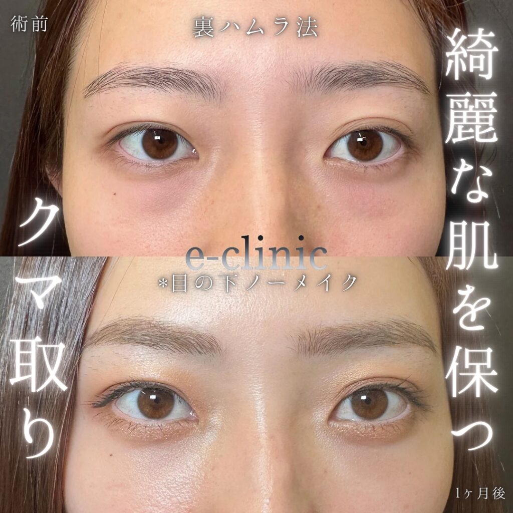 裏ハムラ法の症例写真 (7)