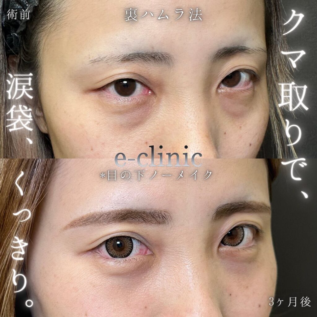 裏ハムラ法の症例写真 (9)