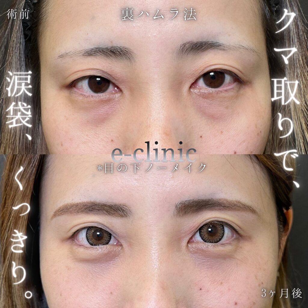 裏ハムラ法の症例写真 (10)