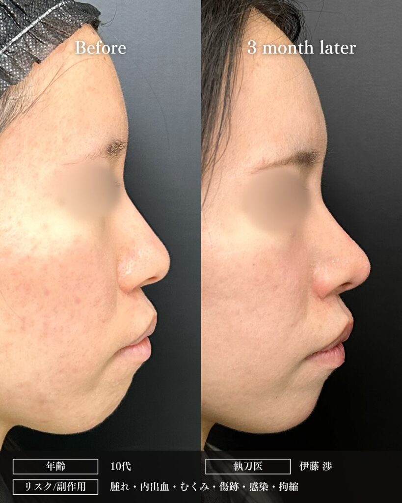 鼻尖形成と軟骨移植と小鼻縮小の症例写真 (2)