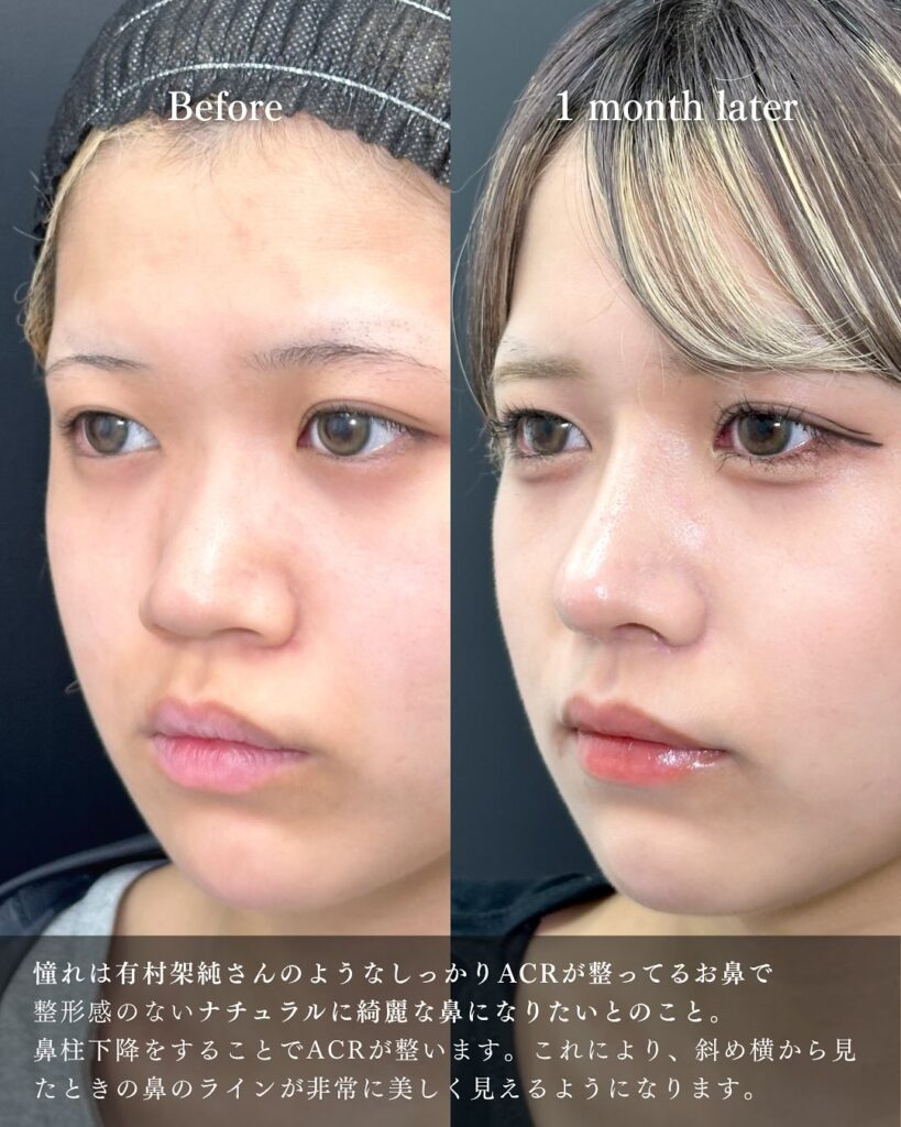 鼻中隔延長と鼻尖形成と軟骨移植と小鼻縮小と鼻柱下降とプロテーゼの症例写真 (2)