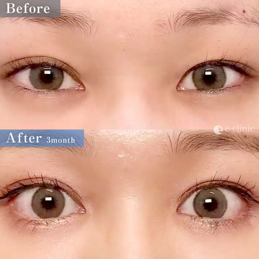 目尻靭帯移動とグラマラスライン形成の症例