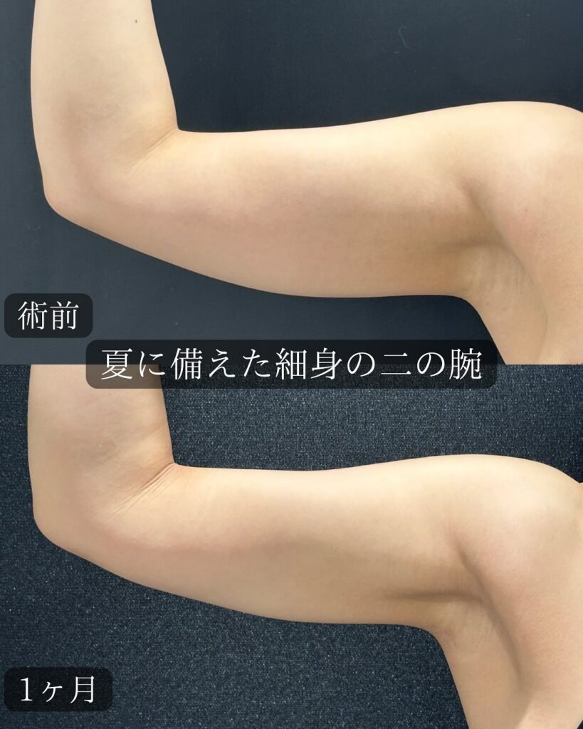 二の腕の脂肪吸引の症例写真 (8)