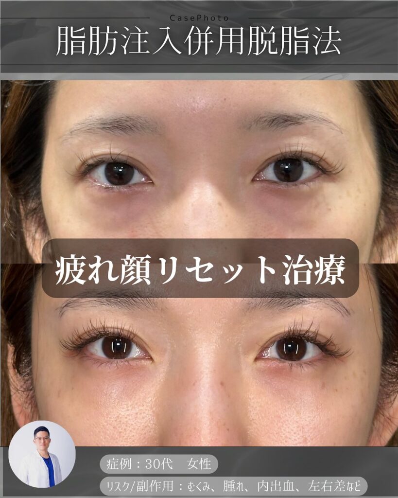 目の下の脂肪注入と脱脂の症例写真 (4)