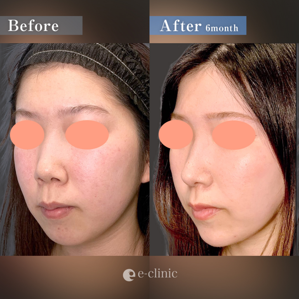 鼻中隔延長耳介と鼻背軟骨移植と鼻尖形成と軟骨移植とメーラーファットと頬と顎下の脂肪吸引と顎のヒアルロン酸の症例写真 (1)