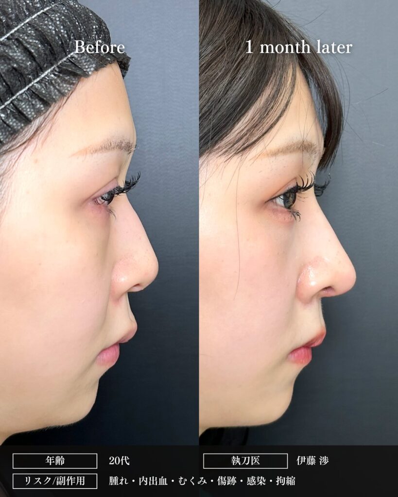 鷲鼻修正と軟骨移植と鼻尖形成と鼻中隔延長の症例写真 (1)