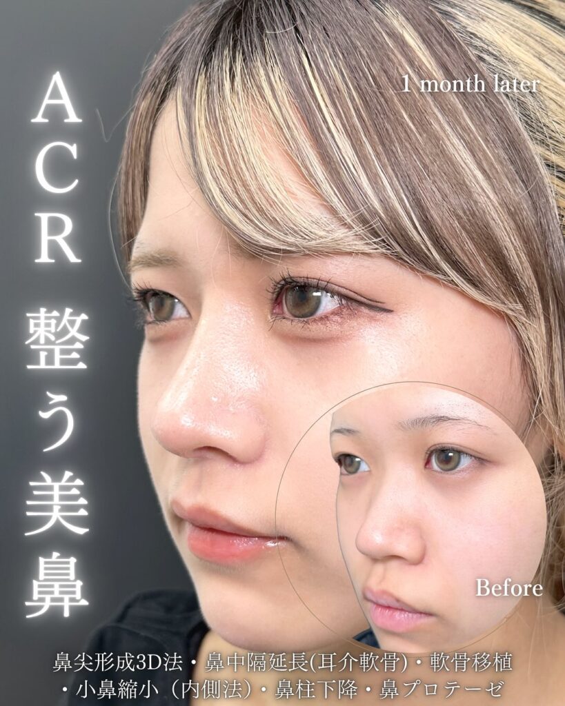 鼻中隔延長と鼻尖形成と軟骨移植と小鼻縮小と鼻柱下降とプロテーゼの症例写真 (1)
