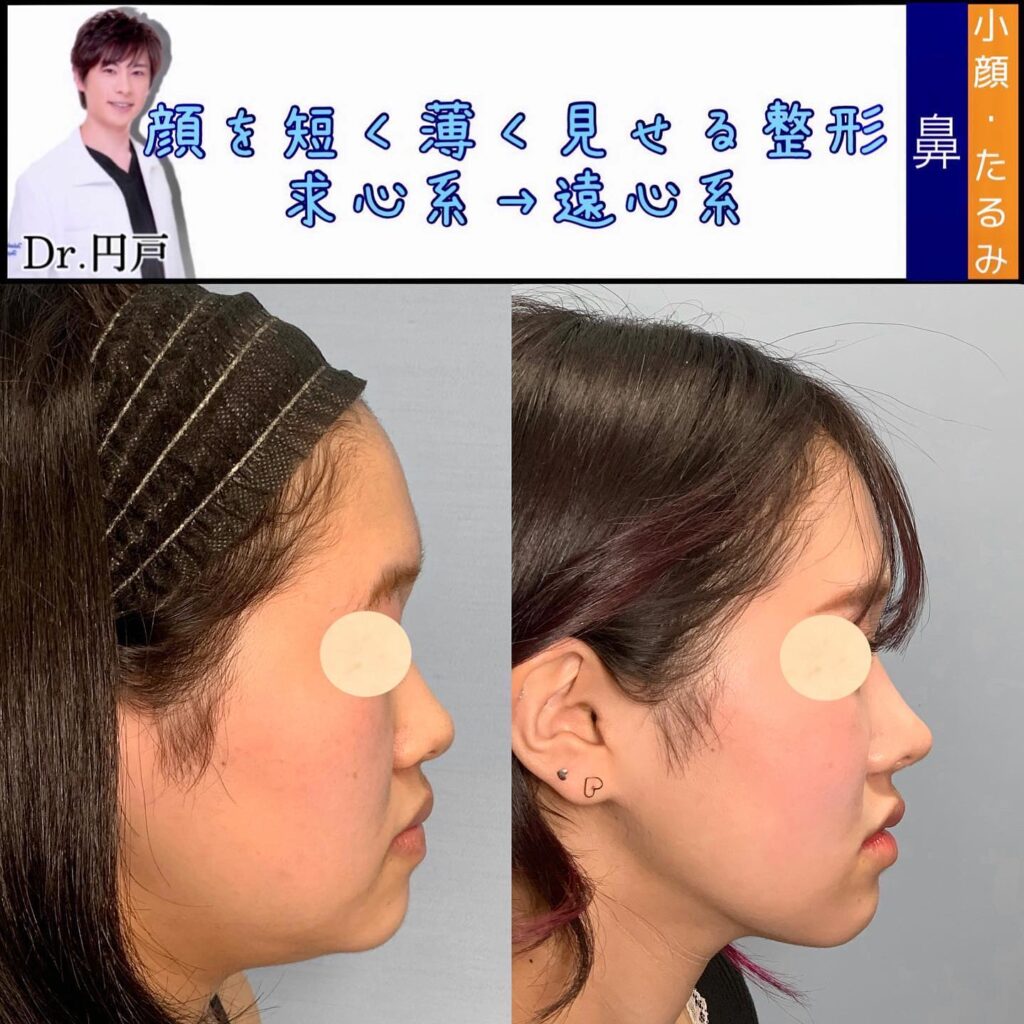 目尻切開と目尻靭帯移動とタレ目形成と眉下切開と鼻のプロテーゼと鼻尖形成と軟骨移植と鼻中隔延長と小顔脂肪吸引と脂肪注入と糸リフトと貴族手術の症例写真 (2)