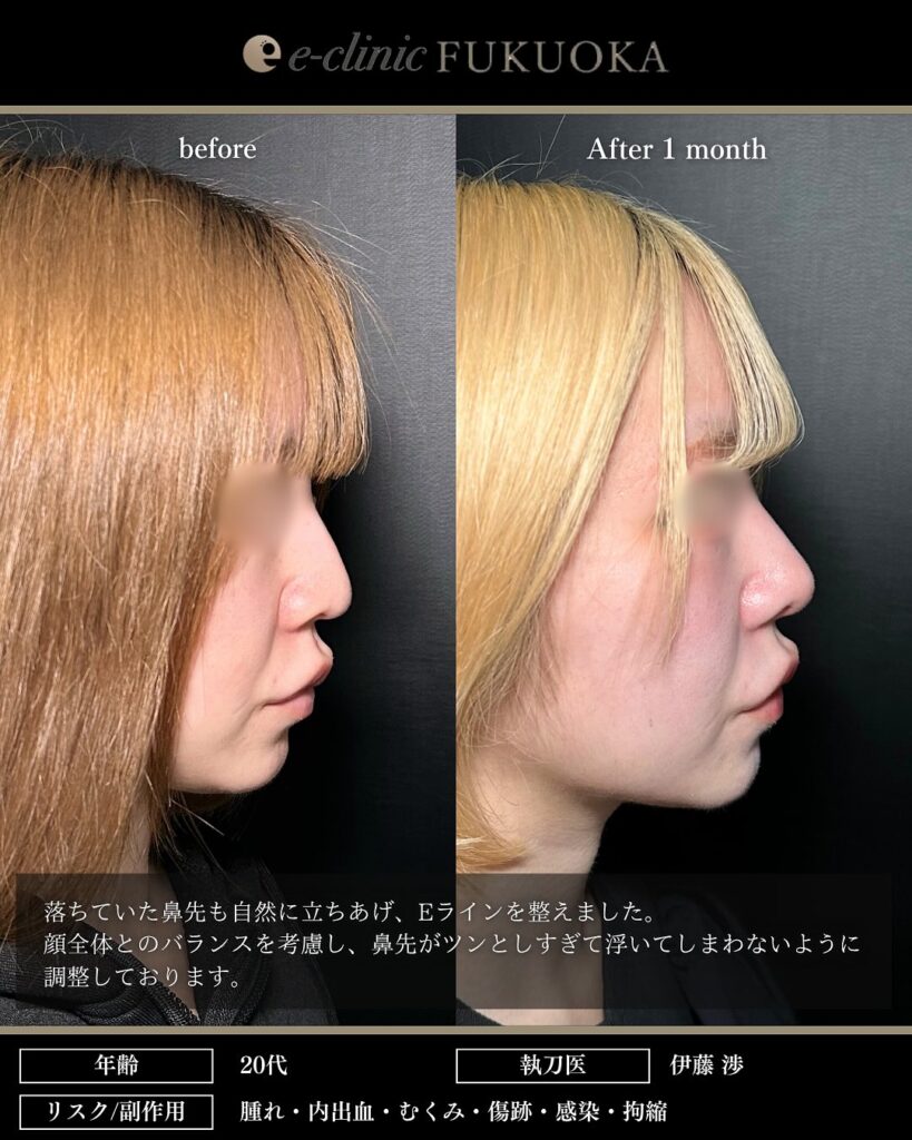 鼻尖形成と耳介軟骨移植と小鼻縮小内側法の症例写真 (3)