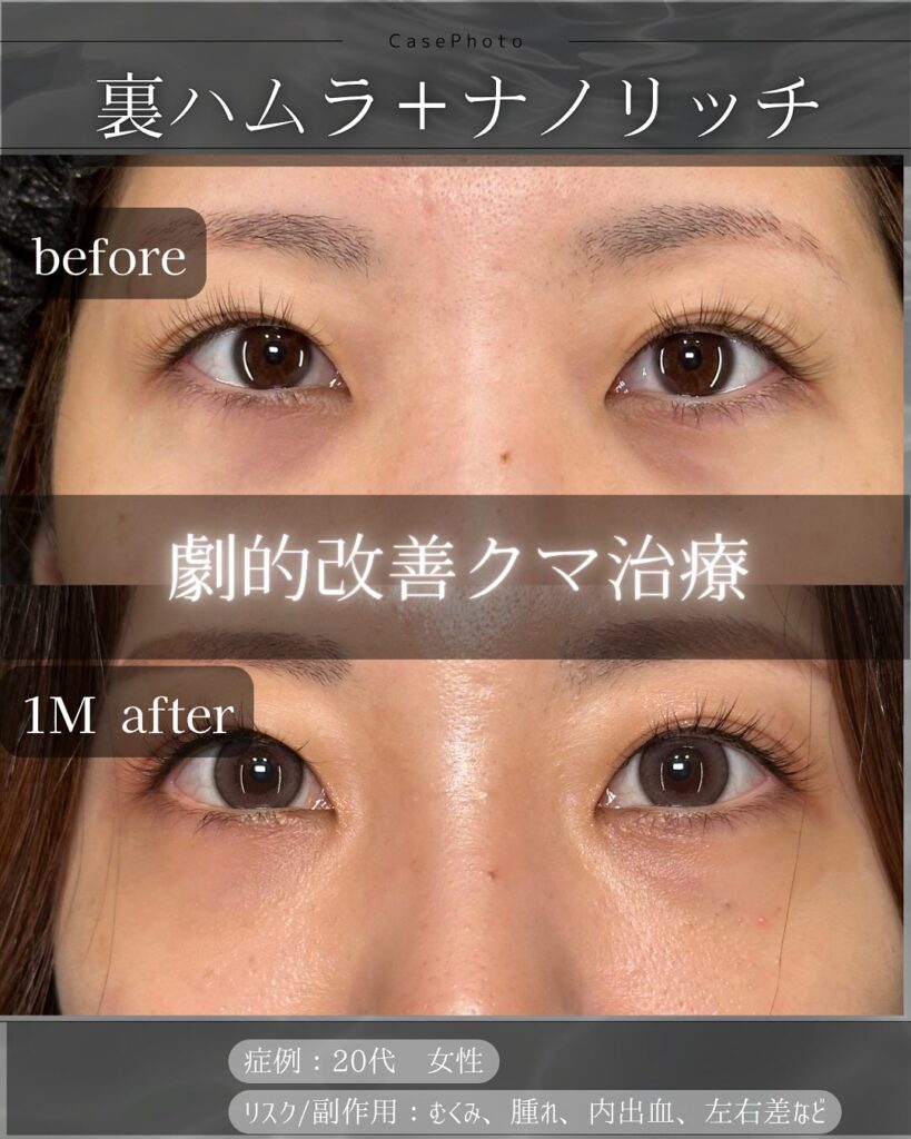 裏ハムラ法とナノリッチの症例写真 (1)