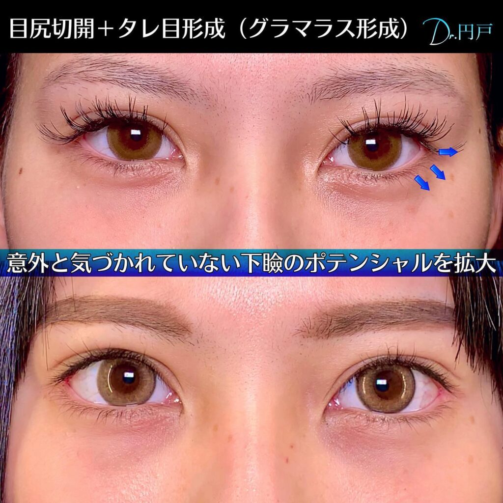 目尻切開（目尻靭帯移動）とタレ目（グラマラス）形成の症例写真