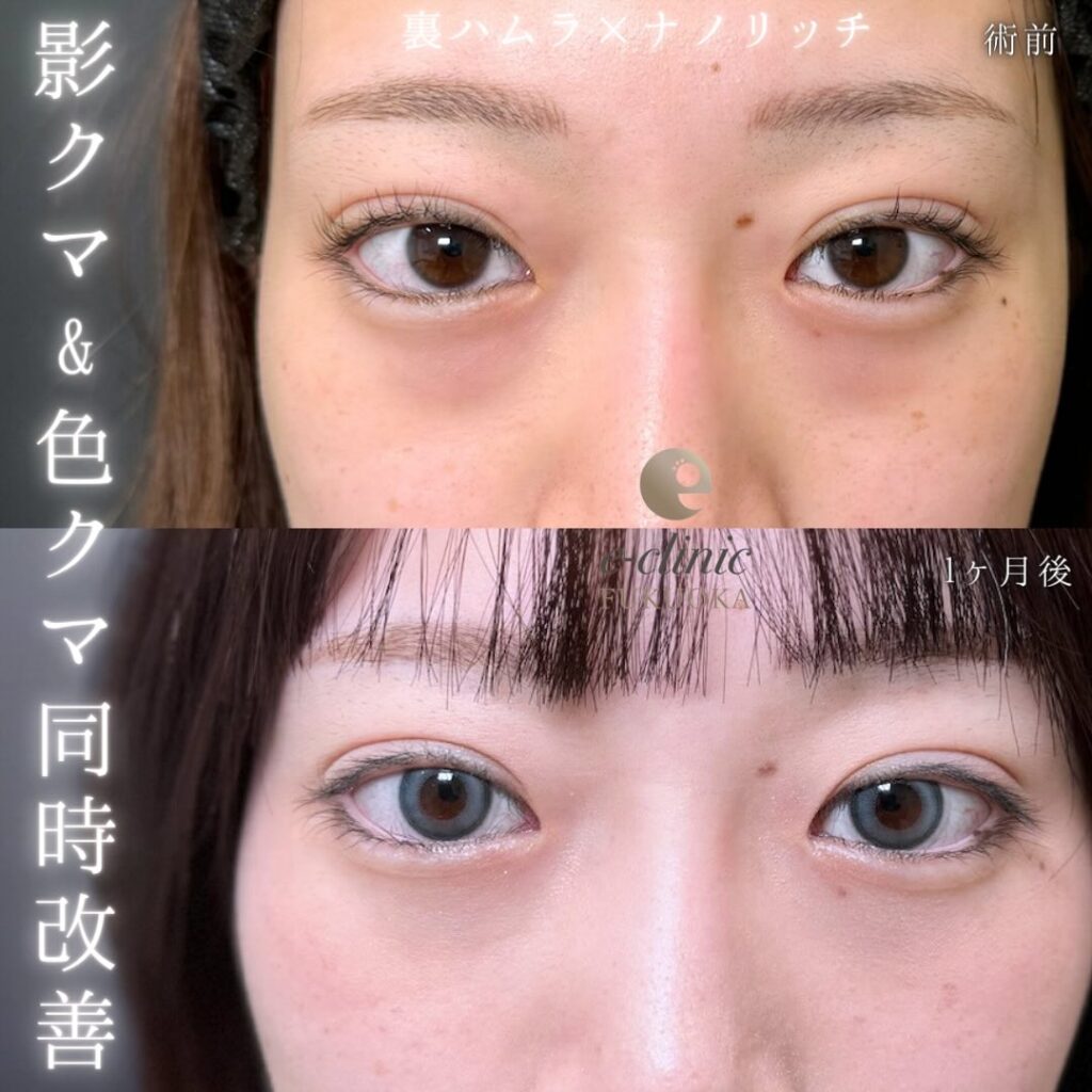 裏ハムラ法とナノリッチの症例写真 (4)